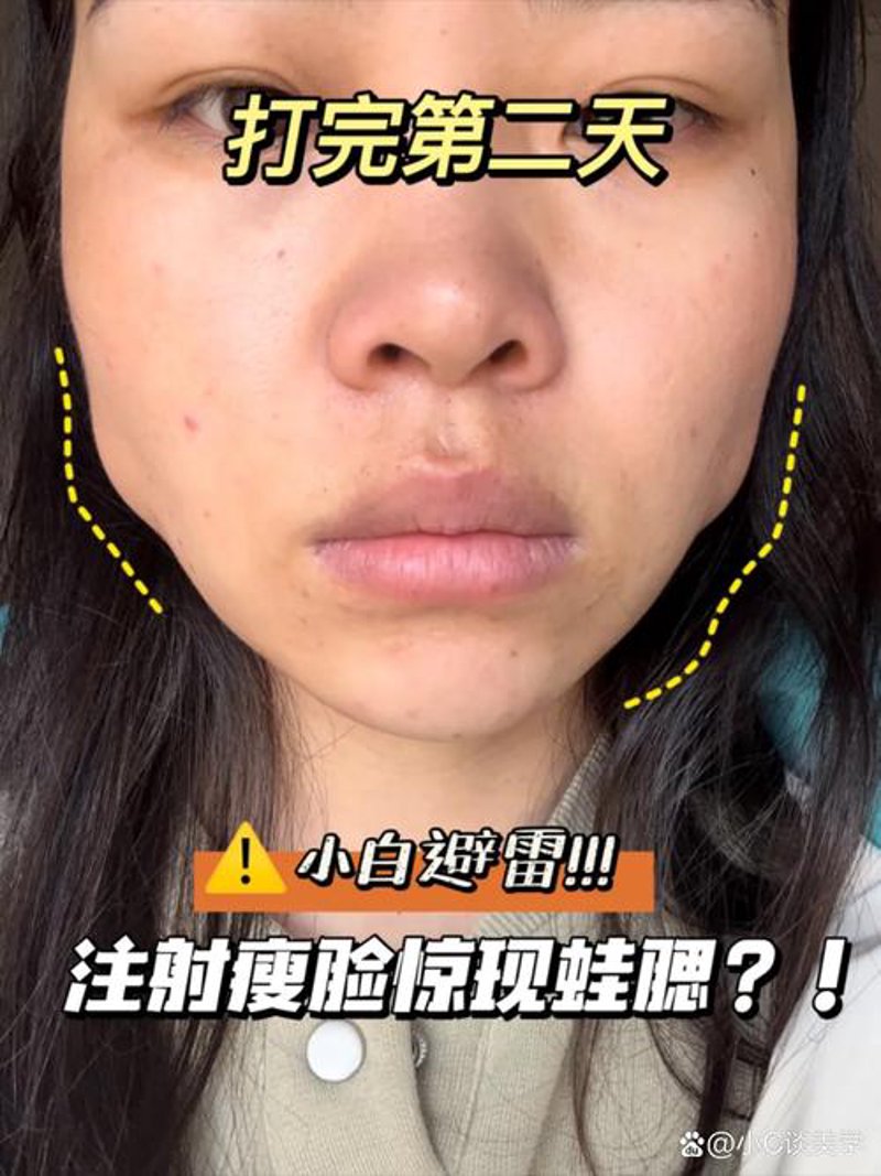 双眼皮手术